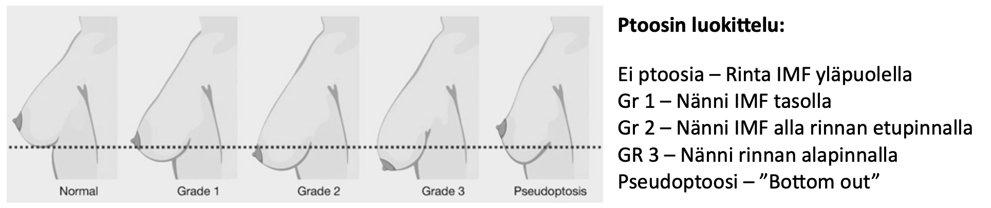 Ptoosin luokittelu: Normal, Grade 1, Grade 2, Grade 3 ja Pseudoptosis.